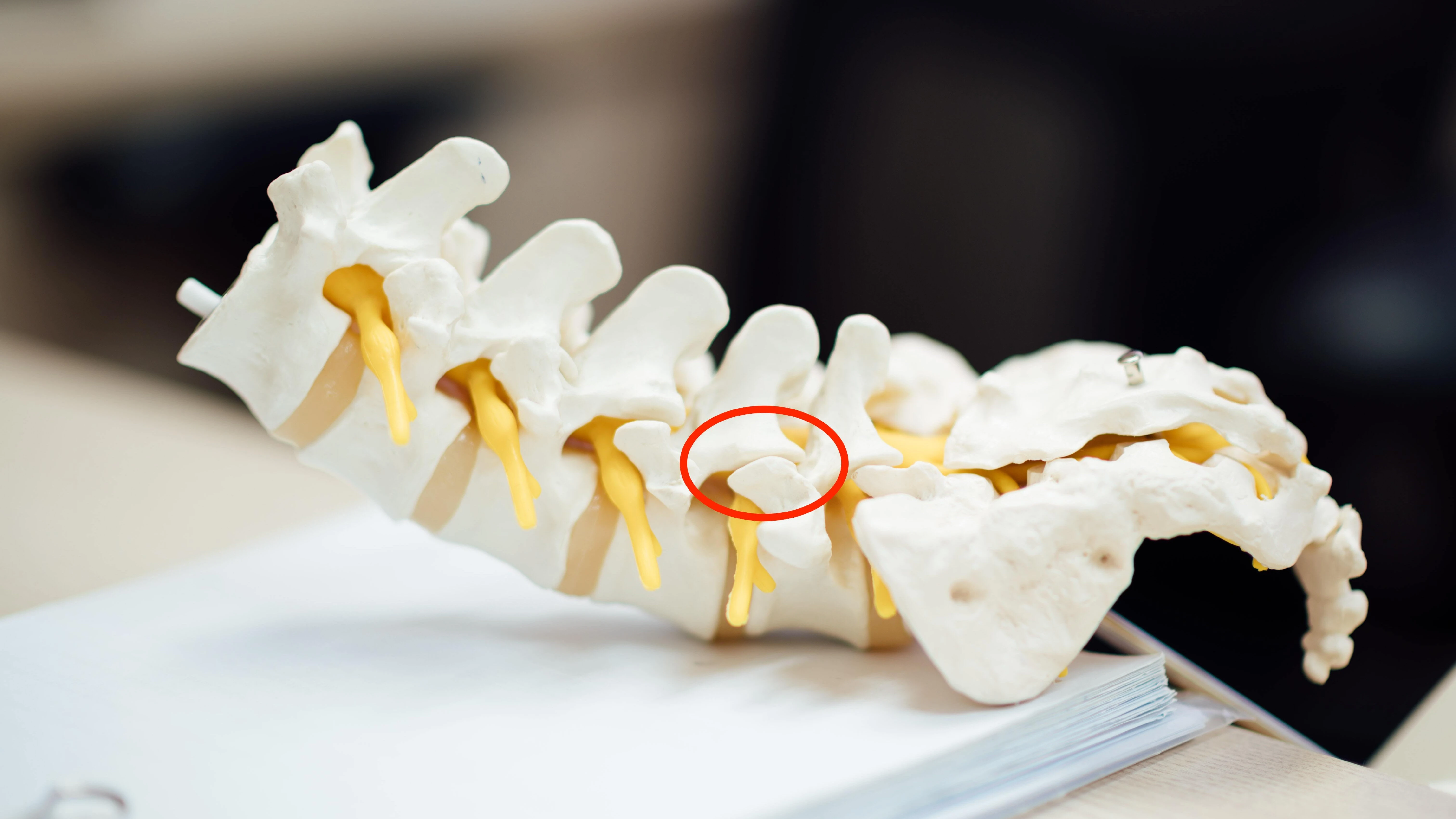 Spondylarthrose Spondylarthrose