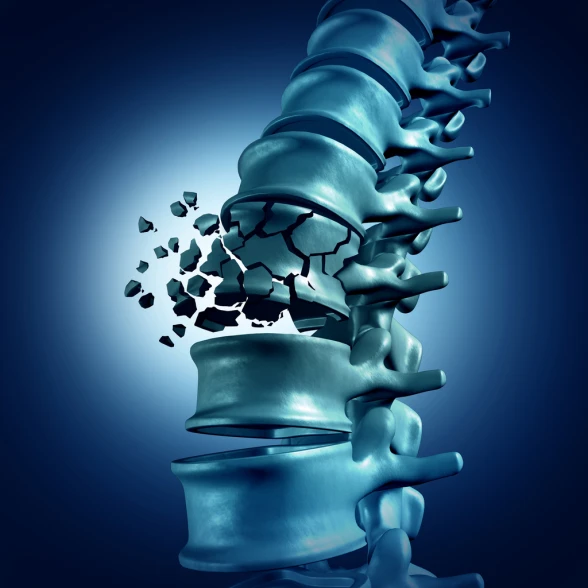 Osteoporose Osteoporose