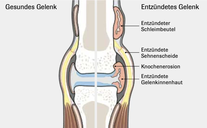 Grafik Gesundes Gelenk Entzündetes Gelenk