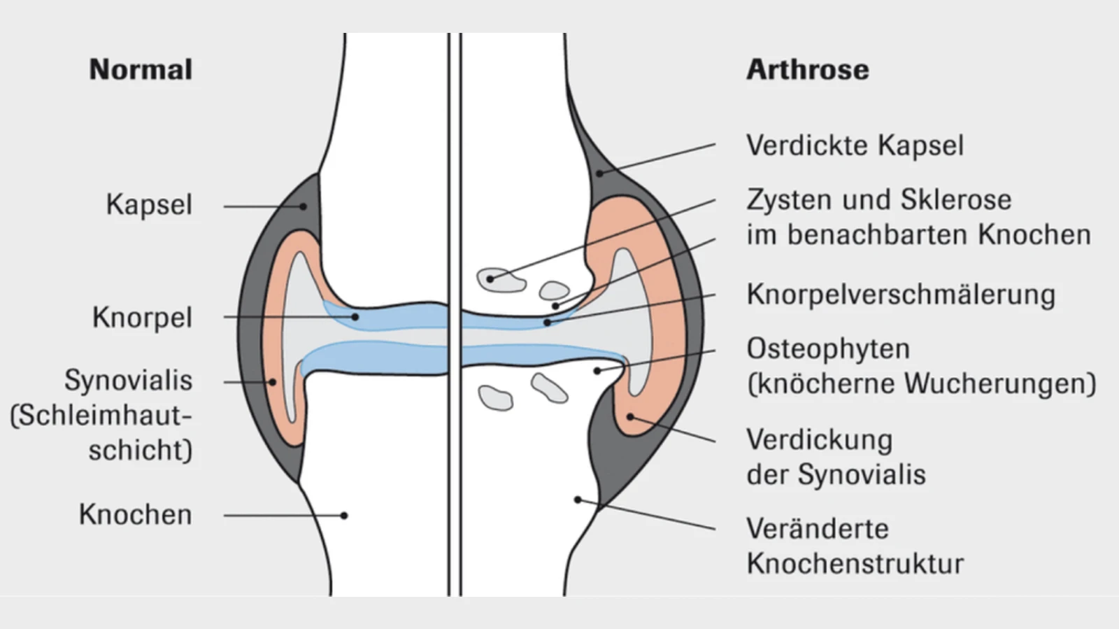 Arthrose Grafik Arthrose Grafik
