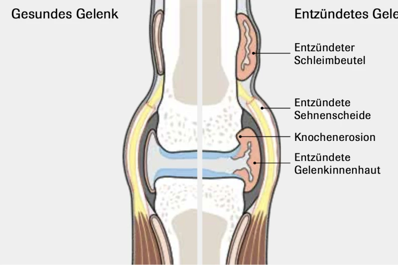 Gesundes Gelenk, entzündetes Gelenk Schematische Darstellung des Gelenkes: gesund und mit Arthritis