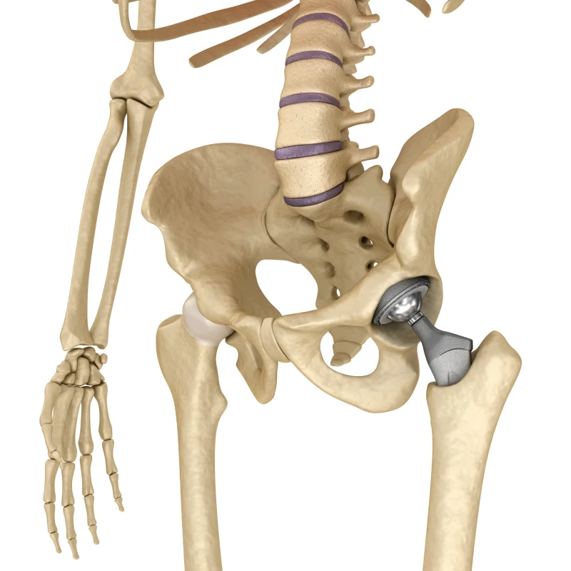 Huftprothese - © iStockphoto Hüftprothese am Skelett