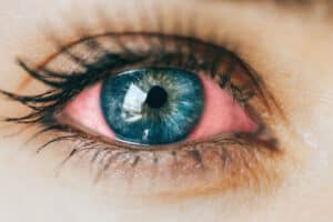 Rotes Auge