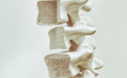 Osteoporose Wirbelsaule