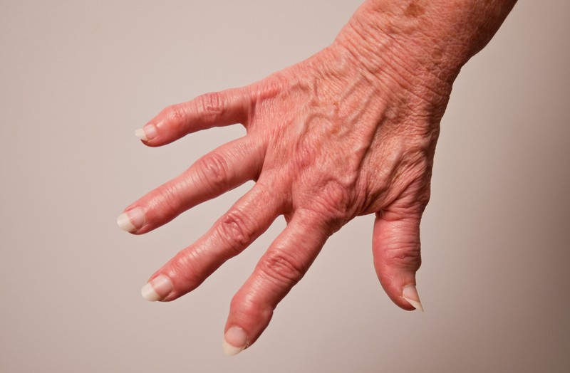 Arthrose der Fingergelenke Rheumaliga Schweiz