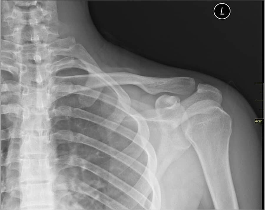 Radiografia della spalla