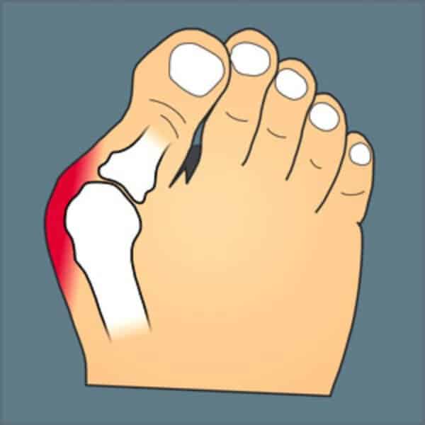 Hallux Valgus