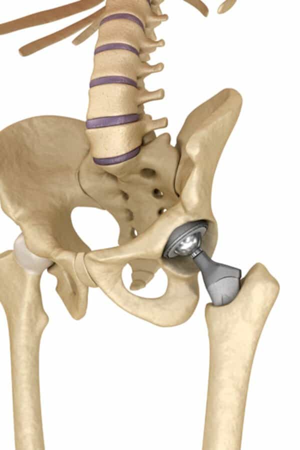 Protesi dell’anca