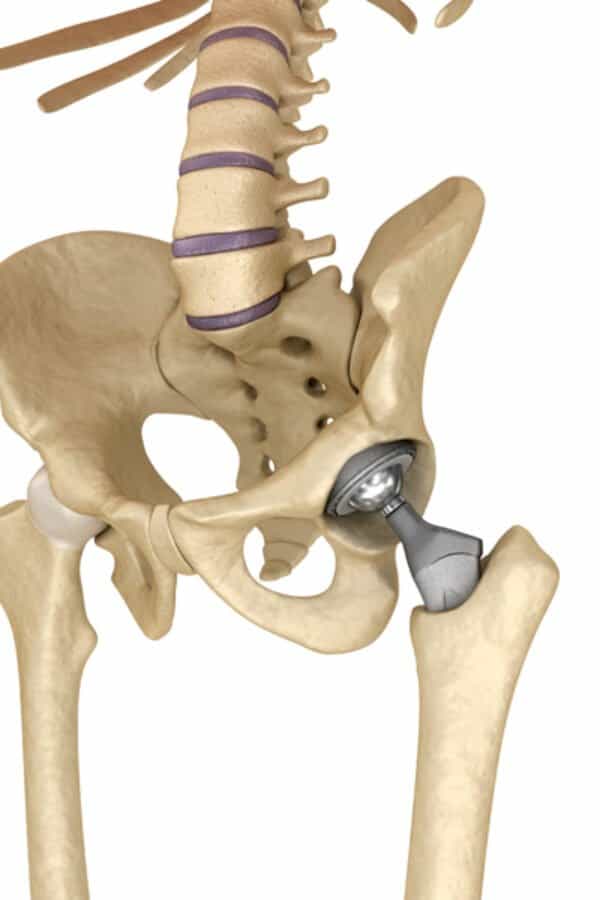 Hüftprothese am Skelett
