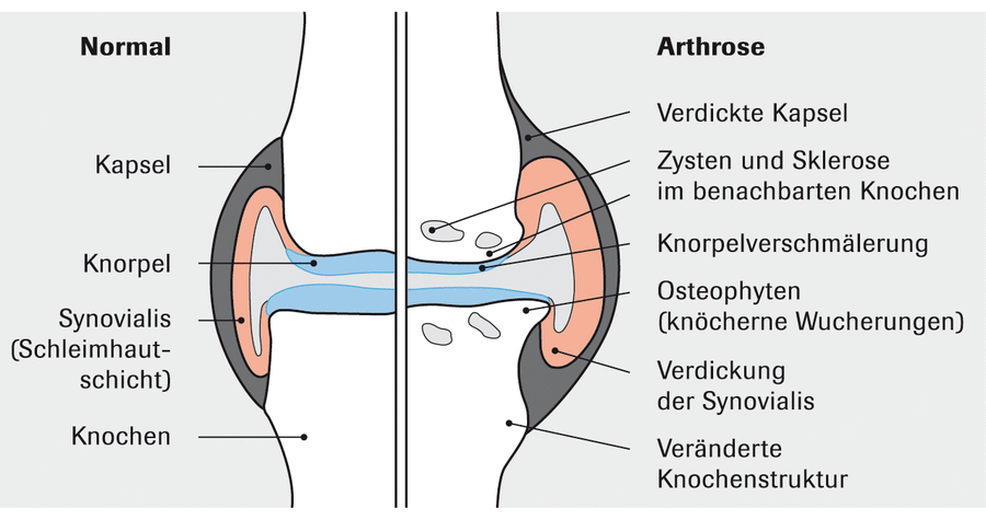 Illustration eines Gelenkes ohne und mit Arhtrose