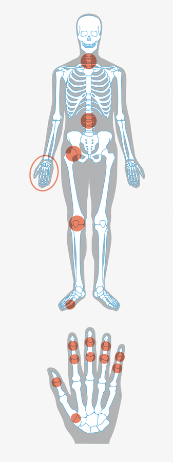 Illustration eines Skelettes mit rot markierten Gelenken, in denen häufig Arthrose auftritt