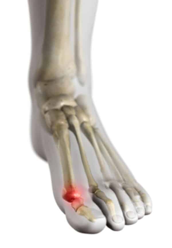 Grosszehengrundgelenk Grosszehengrundgelenk