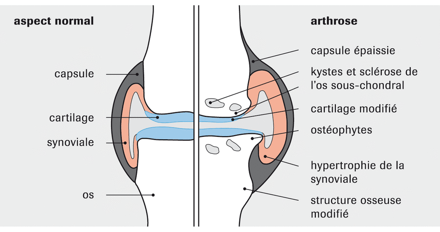 L'arthrose : Causes, Symptômes, Prévention et Traitement de l'arthrose